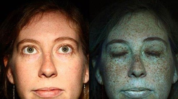 Cancer de la peau liées au bronzage