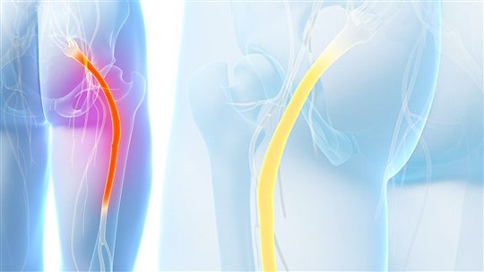 Cruralgie ou sciatique