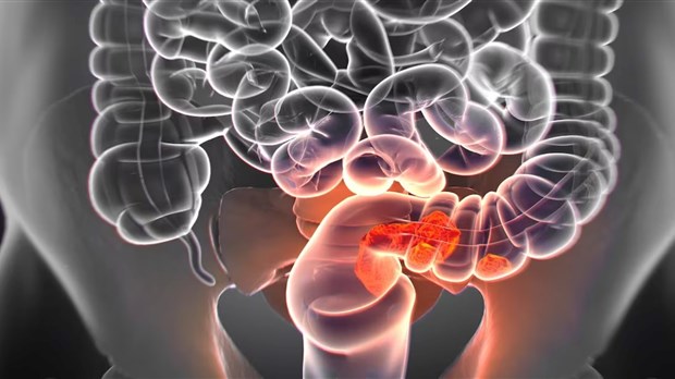  Un accès plus facile au dépistage du cancer colorectal