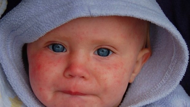 Health: Measles is back  