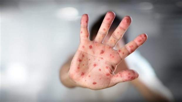 Faites-vous vacciner contre la rougeole 