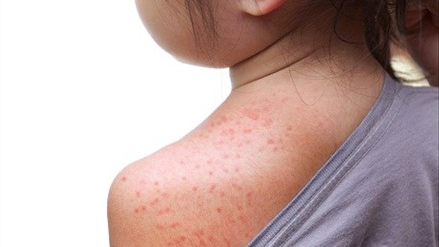 Rougeole: 44,4% des lecteurs craignent une recrudescence de la maladie 