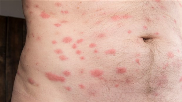 Les punaises de lit : comment en venir à bout ? 